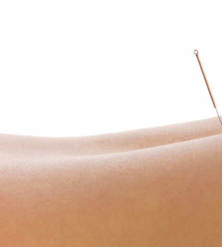 Acupuncture