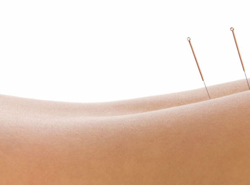 Acupuncture