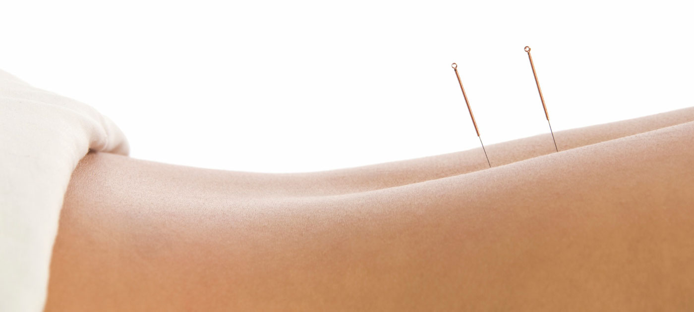 Acupuncture